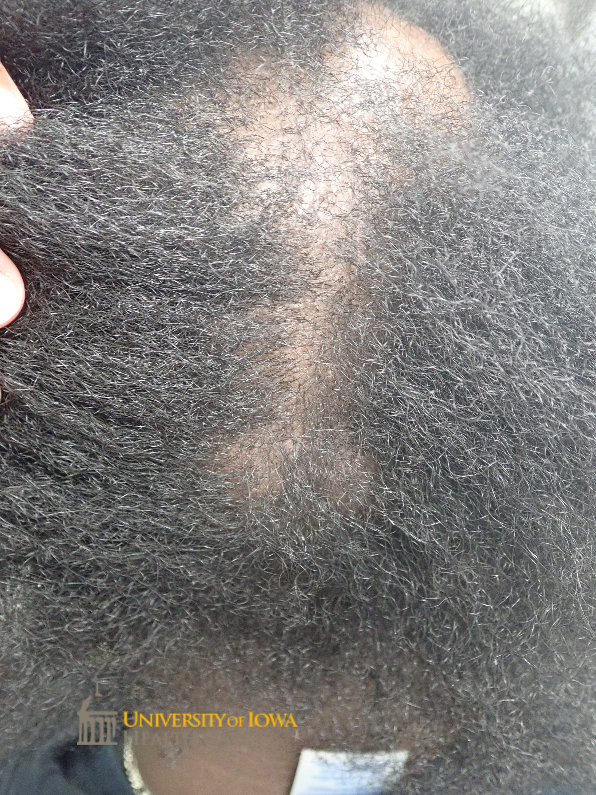 A large patch of scarring alopecia with irregular borders and with some retained hair follicles on the anterior and vertex scalp. (click images for higher resolution).